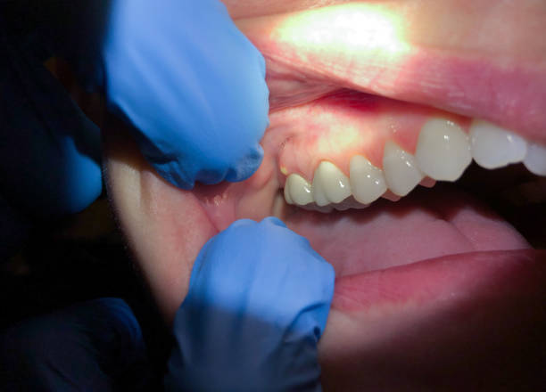 Best Emergency Treatment for Toothache in Glassboro, NJ